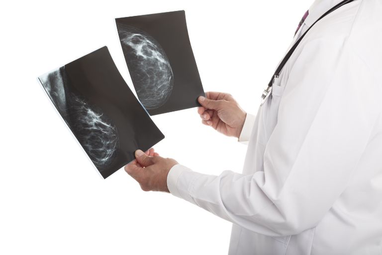 Breast Density and BMI Both Play a Role in Breast Cancer Risk
